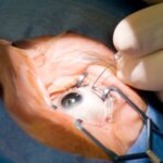 Israel realiza implante de córnea impressa em 3D